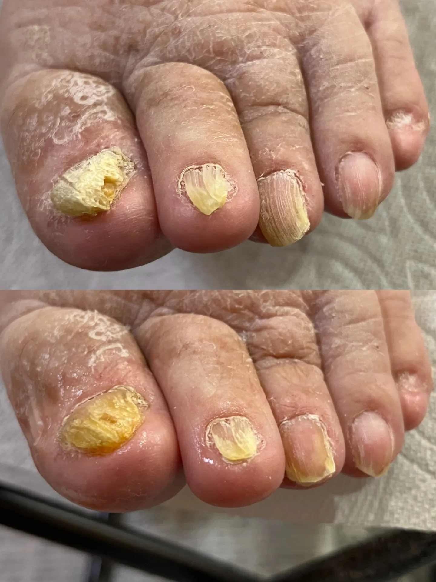 白癬菌の繁殖を防ぐために